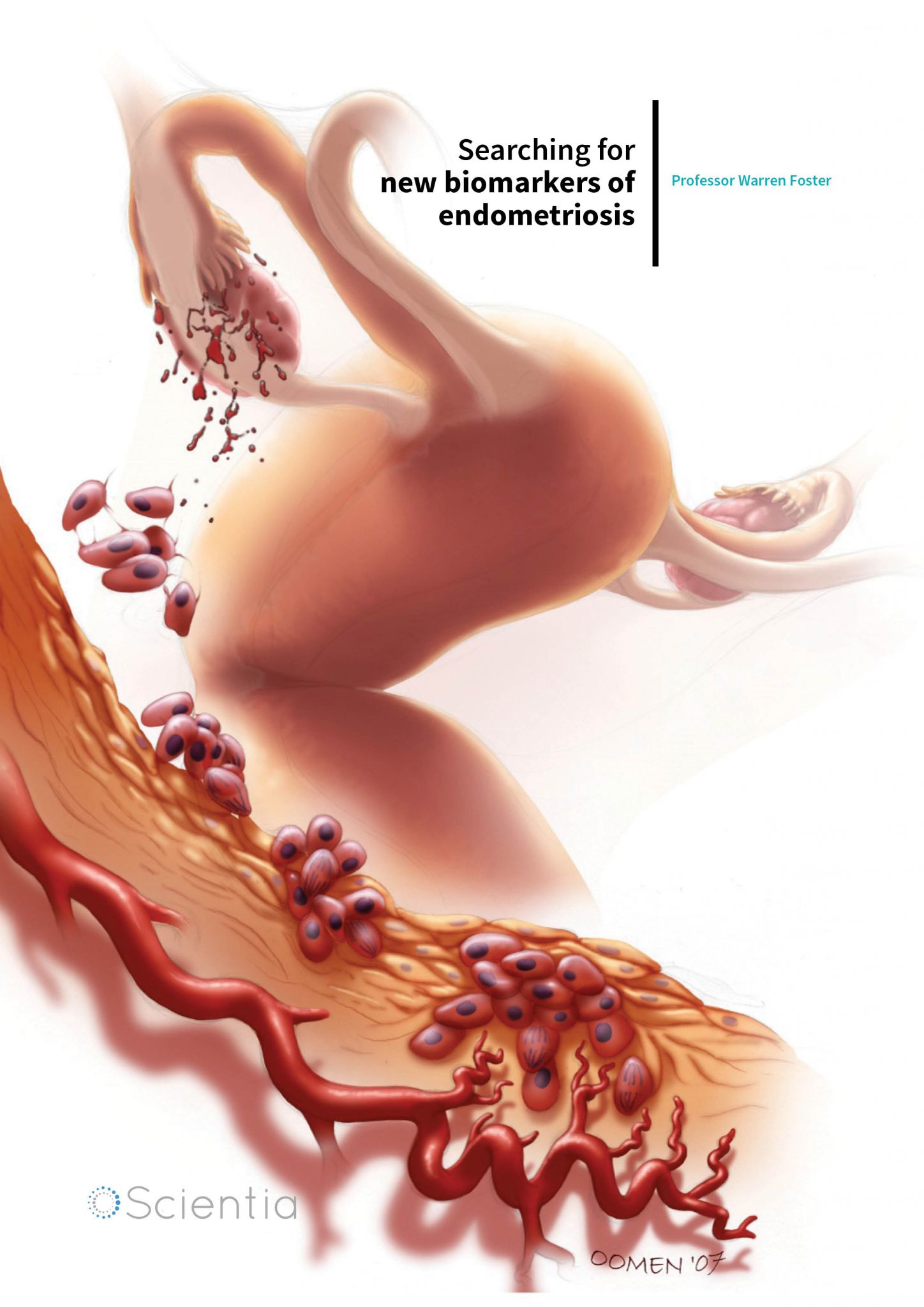 Professor Warren Foster – Searching For New Biomarkers Of Endometriosis