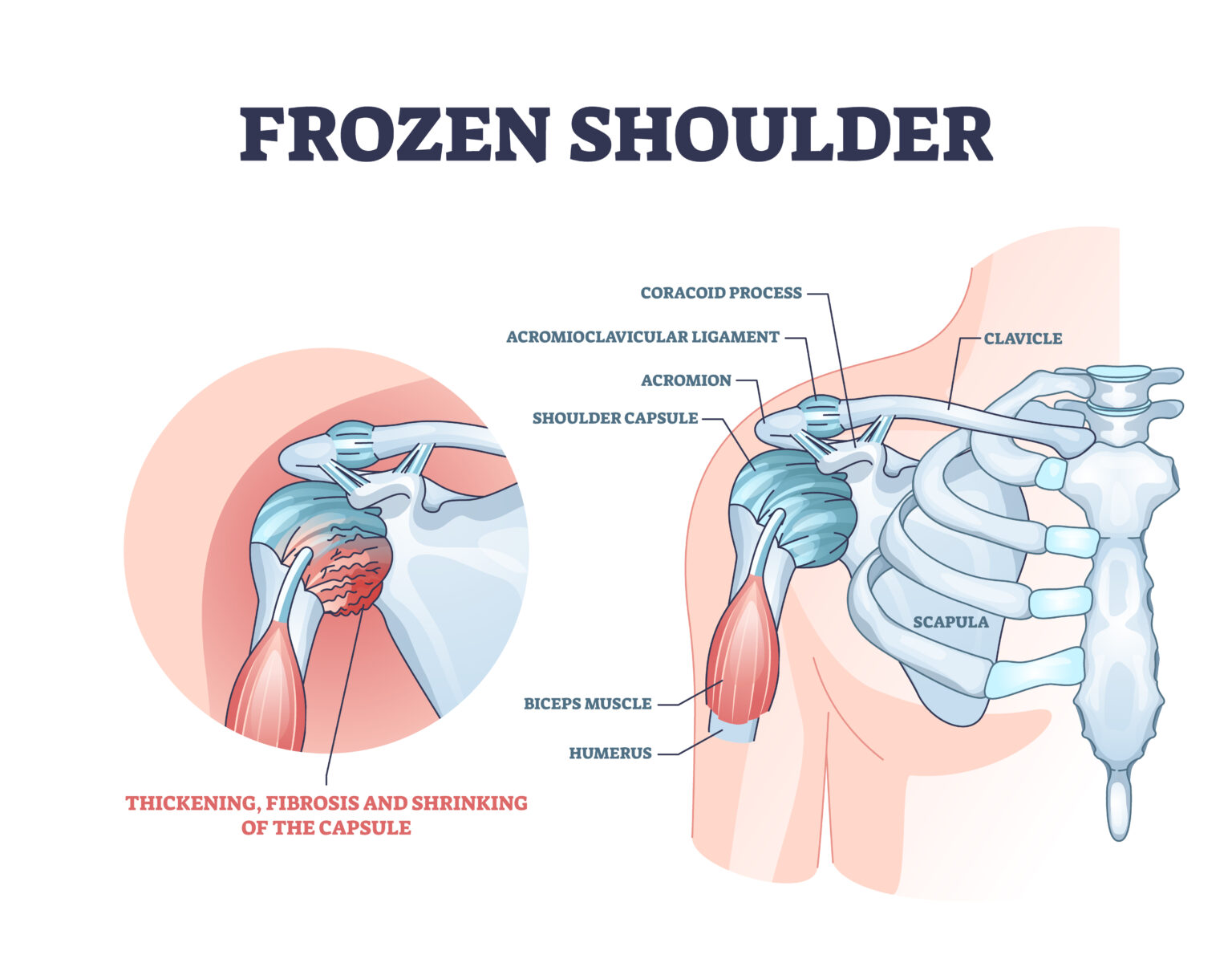 Ken R Shoulders Dr Kenneth Cutbush | Freeing Frozen Shoulders: The 360° Release ...