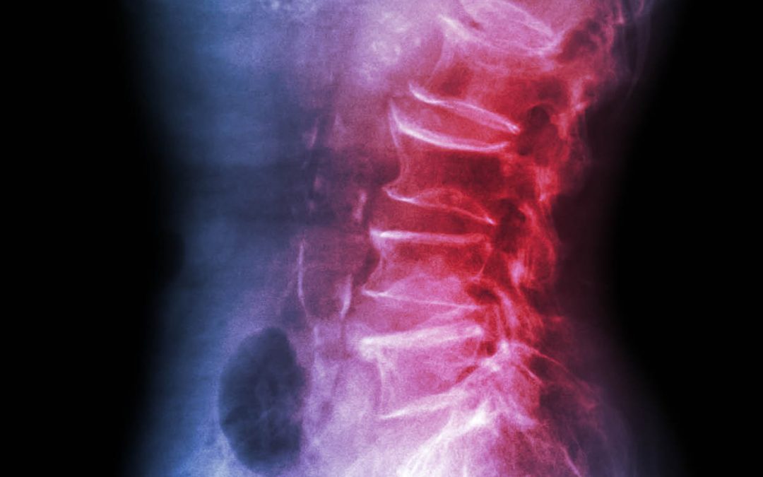 Dr Andrew King | Exploring New Surgical Approaches For Treating Back Pain In Adolescents