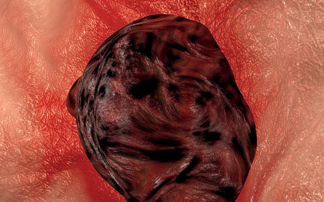 Dr Chengyu Liang – The Discovery of a Novel and Predictive Biomarker in Melanoma