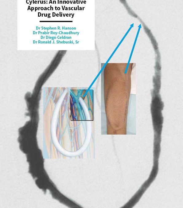 Cylerus: An Innovative Approach to Vascular Drug Delivery
