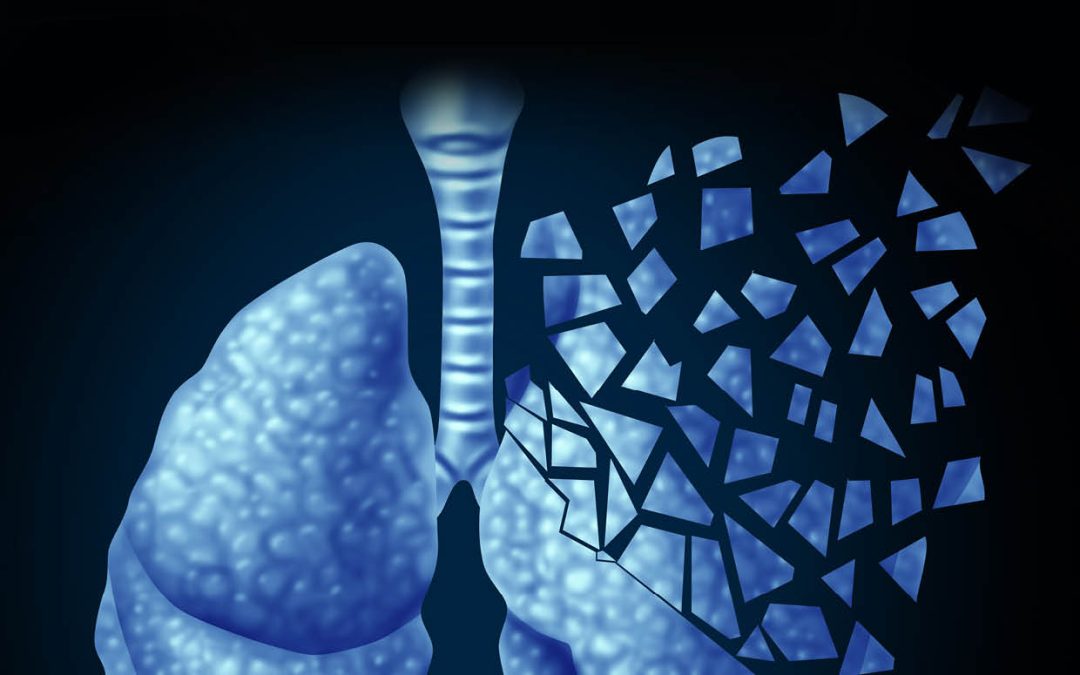 Dr Jean Pfau | A Novel Autoimmune Disease Linked to Asbestos Exposure